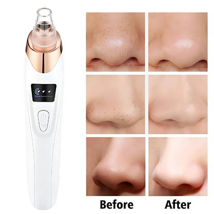 5 in 1 Rechargeable Blackhead Remover